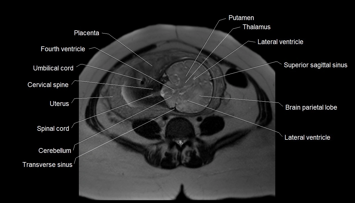 MRI fetal anatomy axial image 22.webp